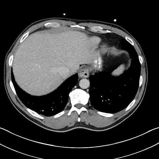 Closed loop small bowel obstruction - internal hernia (Radiopaedia 57806-64778 B 17).jpg
