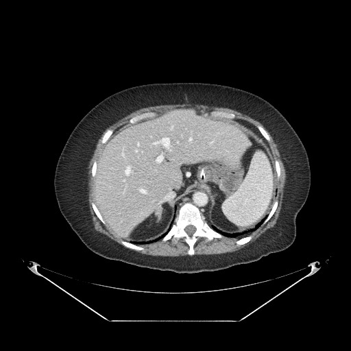 Closed loop small bowel obstruction - internal hernia (Radiopaedia 65402-74450 A 20).jpg