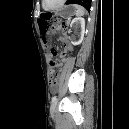 Closed loop small bowel obstruction - omental adhesion causing "internal hernia" (Radiopaedia 85129-100682 C 126).jpg