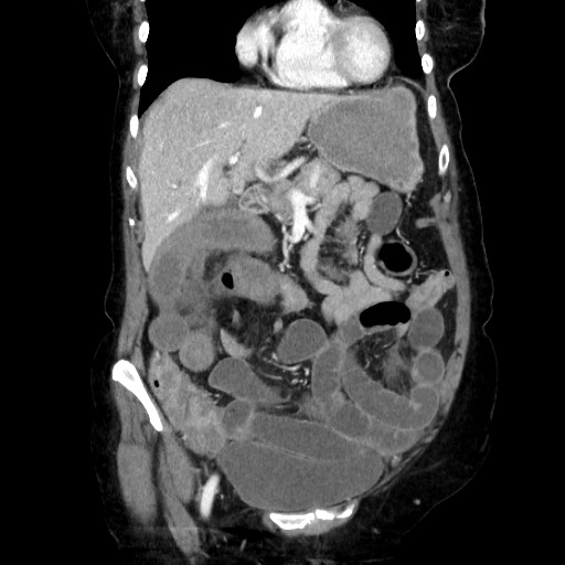 Closed loop small bowel obstruction due to adhesive band, with intramural hemorrhage and ischemia (Radiopaedia 83831-99017 C 44).jpg