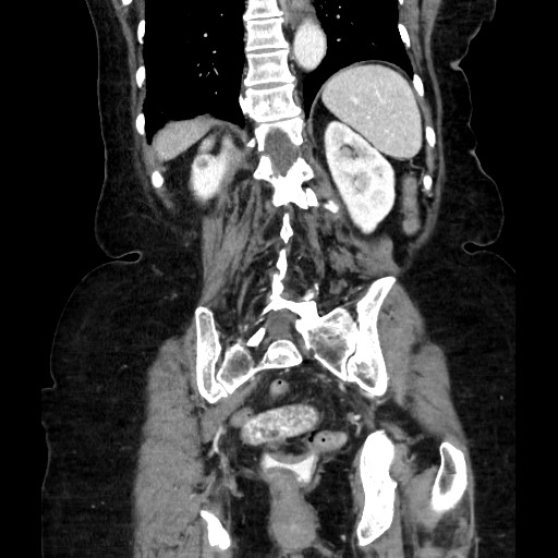 File:Closed loop small bowel obstruction due to adhesive band, with intramural hemorrhage and ischemia (Radiopaedia 83831-99017 C 93).jpg