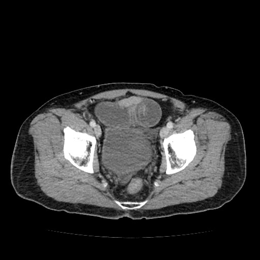 File:Closed loop small bowel obstruction due to adhesive band - U-shaped loop (Radiopaedia 83829-99012 A 62).jpg