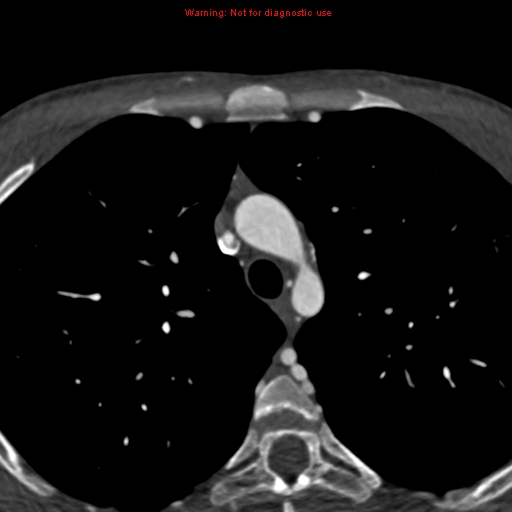 File:Coarctation of the aorta (Radiopaedia 12461-12697 A 72).jpg