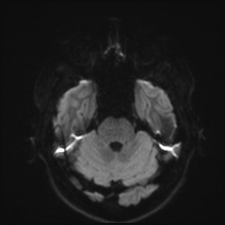 File:Cochlear incomplete partition type III associated with hypothalamic hamartoma (Radiopaedia 88756-105498 Axial DWI 52).jpg