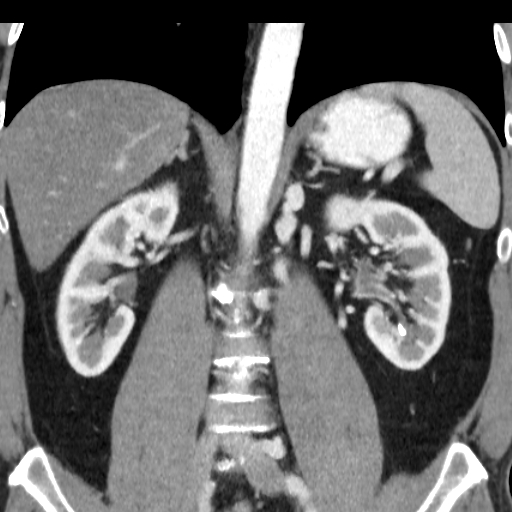 File:Collateral circulation following left renal vein thrombosis (Radiopaedia 17319-17013 renal cortical phase 11).jpg