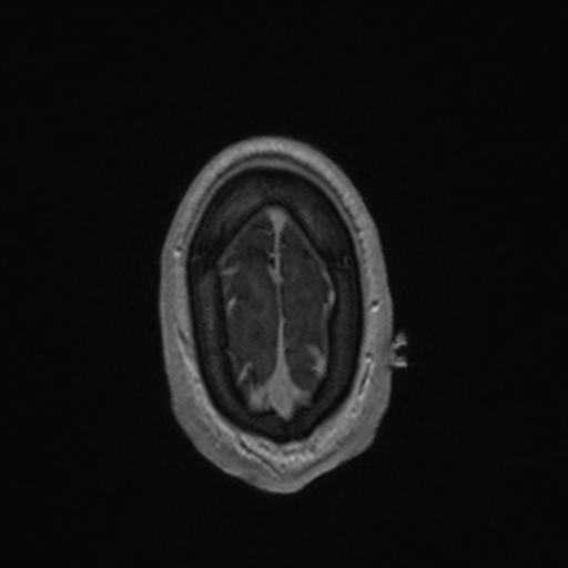 Colloid cyst (Radiopaedia 44510-48181 Axial T1 C+ 165).png