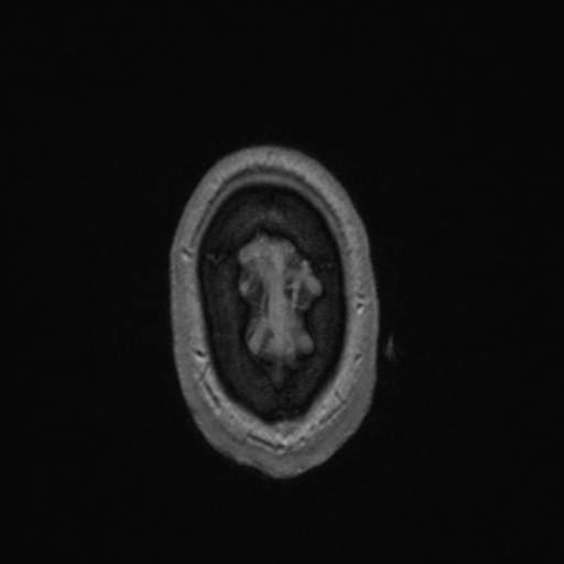 File:Colloid cyst (Radiopaedia 44510-48181 Axial T1 C+ 169).png