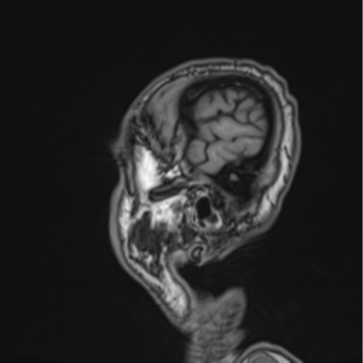 File:Colloid cyst of the third ventricle (Radiopaedia 86571-102662 Sagittal T1 8).png