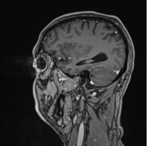 Colloid cyst of the third ventricle (Radiopaedia 86571-102662 Sagittal T1 C+ 21).png
