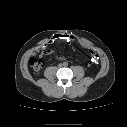 File:Colocutaneous fistula in Crohn's disease (Radiopaedia 29586-30093 D 11).jpg