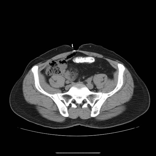 File:Colocutaneous fistula in Crohn's disease (Radiopaedia 29586-30093 D 25).jpg