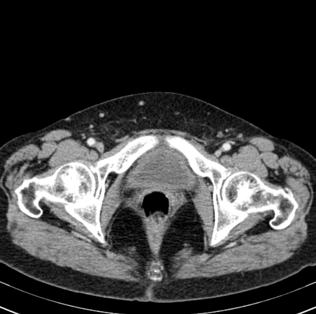 Colon carcinoma with hepatic metastases (Radiopaedia 29477-29961 A 112).jpg
