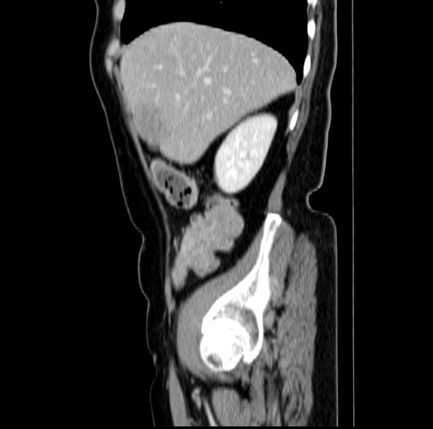 Colon carcinoma with hepatic metastases (Radiopaedia 29477-29961 C 13).jpg