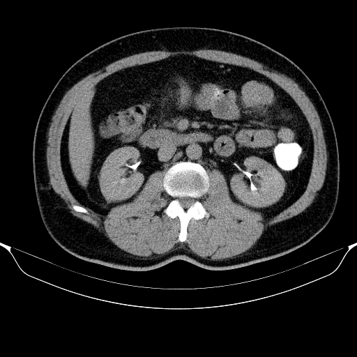 Colonic lipoma with colo-colic intussusception (Radiopaedia 58944-66200 Axial C+ rectal 27).jpg