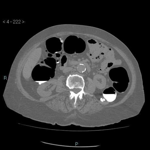 Colonic lipomas (Radiopaedia 49137-54244 Axial bone window 100).jpg