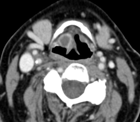 File:Epiglottic cyst (Radiopaedia 15885).jpg