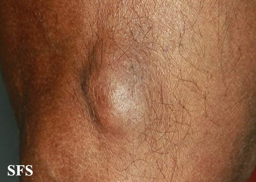 File:Gout (Dermatology Atlas 8).jpg
