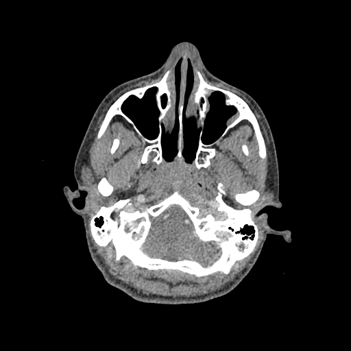 Nasal pyogenic granuloma (lobular capillary hemangioma) (Radiopaedia 85536-101244 C 58).jpg