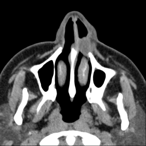 Nasolabial cyst (Radiopaedia 33987-35205 Axial non-contrast 11).jpg