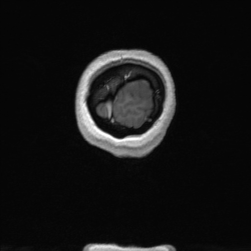 Nasopharyngeal carcinoma (T1 N3a) with complete response (Radiopaedia 61357-69619 Coronal 3D volume 188).jpg