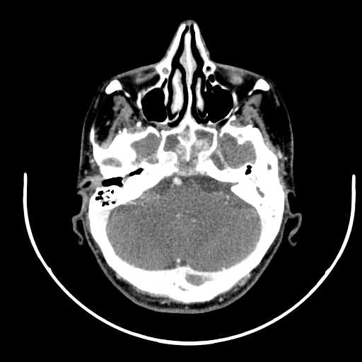 File:Nasopharyngeal carcinoma - infiltrating the clivus (Radiopaedia 62583-70875 Axial Post contrast 9).jpg