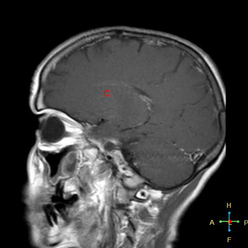 File:Nasopharyngeal carcinoma infiltrating the clivus (Radiopaedia 25229-25481 Sagittal T1 C+ 12).jpg