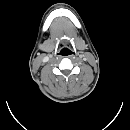 File:Nasopharyngeal carcinoma with pterygopalatine fossa involvement (Radiopaedia 33102-34132 A 35).png