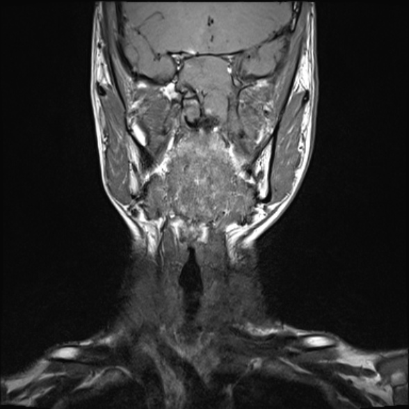 Nasopharyngeal carcinoma with skull base invasion (Radiopaedia 53415-59485 Coronal T1 25).jpg