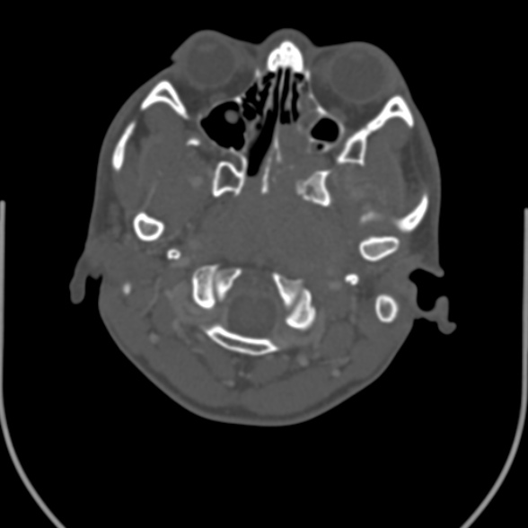 Nasopharyngeal carcinoma with skull base invasion (Radiopaedia 53415-59705 Axial bone window 35).jpg