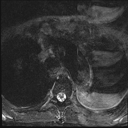 File:Nasopharyngeal carcinoma with skull base invasion (Radiopaedia 59258-66600 Axial T2 fat sat 34).jpg