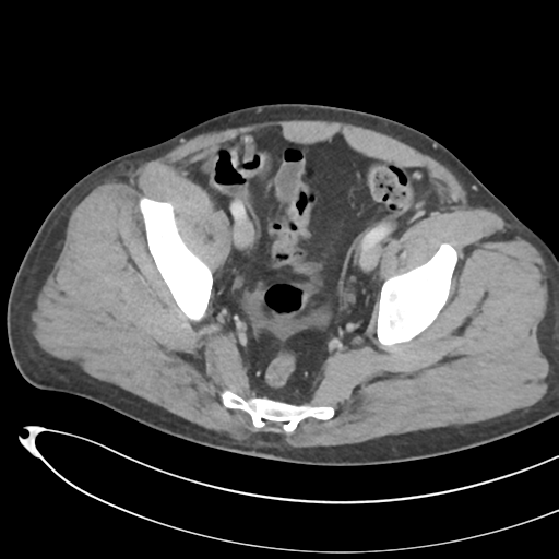 File:Necrotizing pancreatitis with acute necrotic collections (Radiopaedia 38829-41012 B 72).png