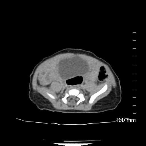File:Neonatal neuroblastoma (Radiopaedia 56651-63438 Axial non-contrast 60).jpg