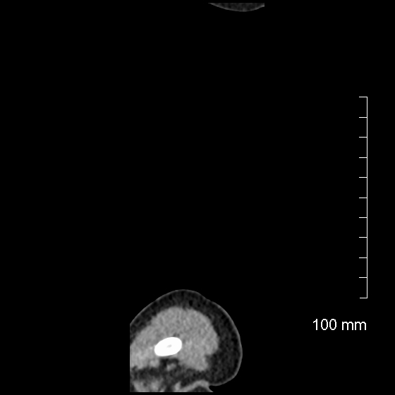 File:Neonatal neuroblastoma (Radiopaedia 56651-63438 C 3).jpg