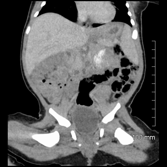 File:Neonatal neuroblastoma (Radiopaedia 56651-63438 Coronal non-contrast 27).jpg
