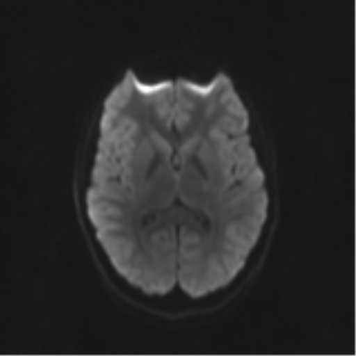 Neurenteric cyst (Radiopaedia 58641-65837 Axial DWI 54).png