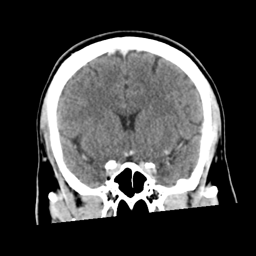 Neurocysticercosis - granular nodular (Radiopaedia 42786-45957 Coronal C+ 26).png