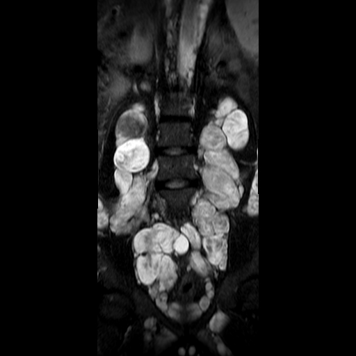 File:Neurofibromatosis type 1- extensive spinal involvement and Christmas tree sign (Radiopaedia 60610-68332 Coronal STIR 7).jpg