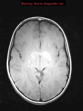 File:Neurofibromatosis type 1 with optic nerve glioma (Radiopaedia 16288-15965 Axial T1 13).jpg
