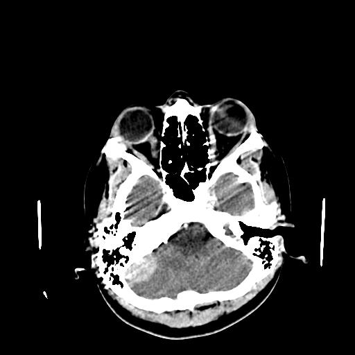 File:Neurofibromatosis type 2 (Radiopaedia 25389-25637 Axial C+ 12).jpg