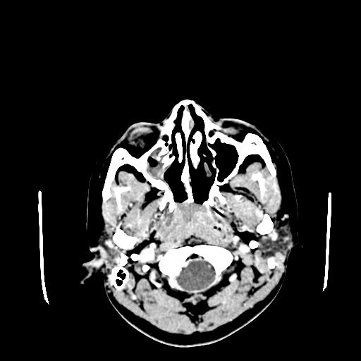 File:Neurofibromatosis type 2 (Radiopaedia 25389-25637 Axial C+ 2).jpg