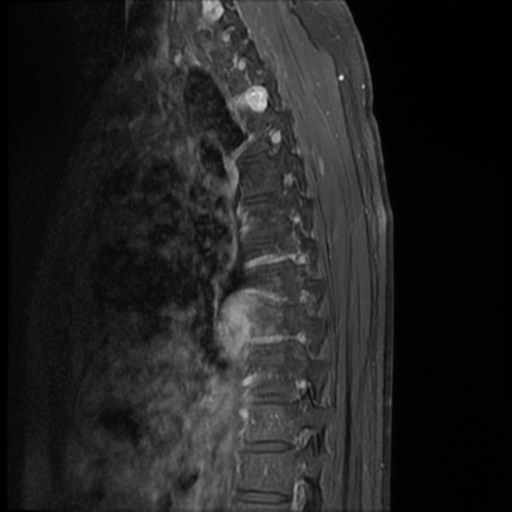 File:Neurofibromatosis type 2 (spinal manifestations) (Radiopaedia 53943-60070 I 11).png