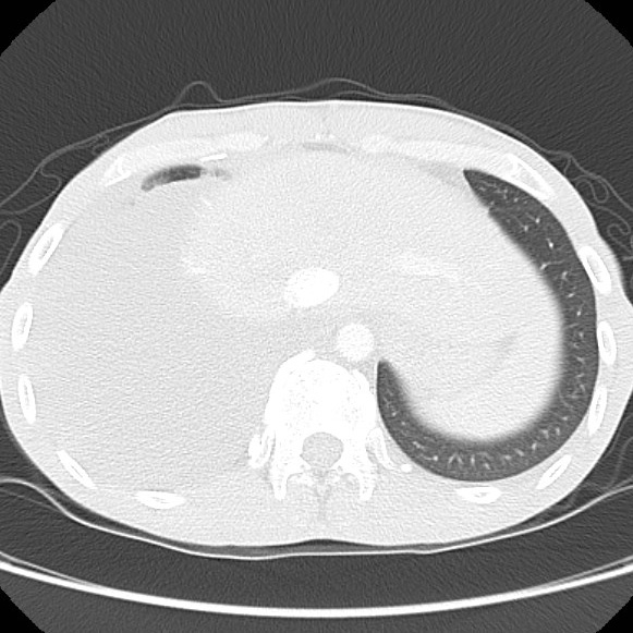 File:Non-Hodgkin lymphoma involving lung (Radiopaedia 29094-29470 Axial lung window 61).jpg