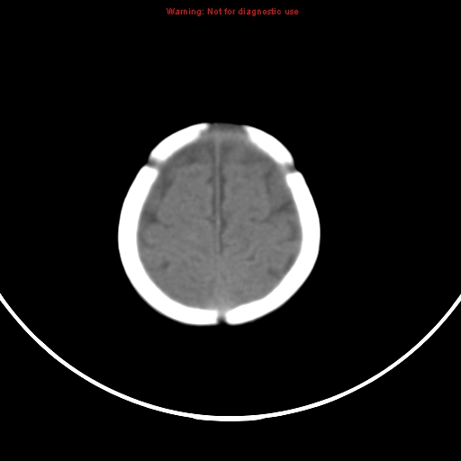 File:Non-accidental injury - bilateral subdural with acute blood (Radiopaedia 10236-10765 Axial non-contrast 20).jpg
