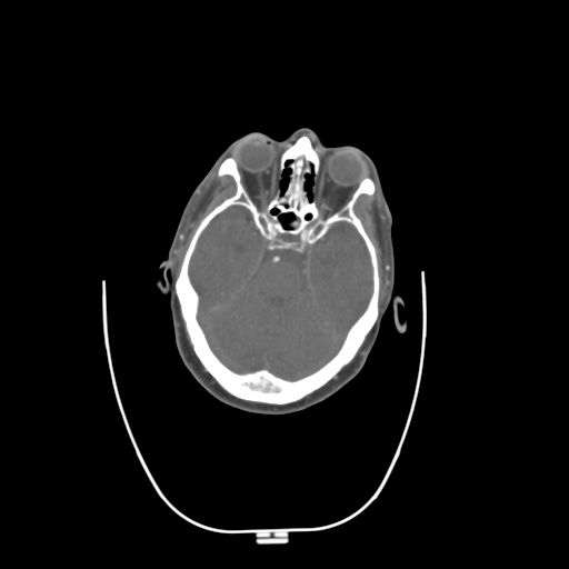 File:Normal CTA head (Radiopaedia 40801-43464 C 1).png
