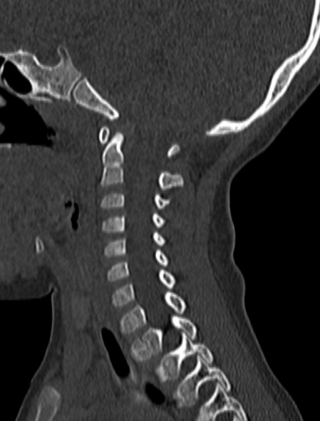 File:Normal CT cervical spine - pediatric (Radiopaedia 52549-58462 Sagittal bone window 127).jpg
