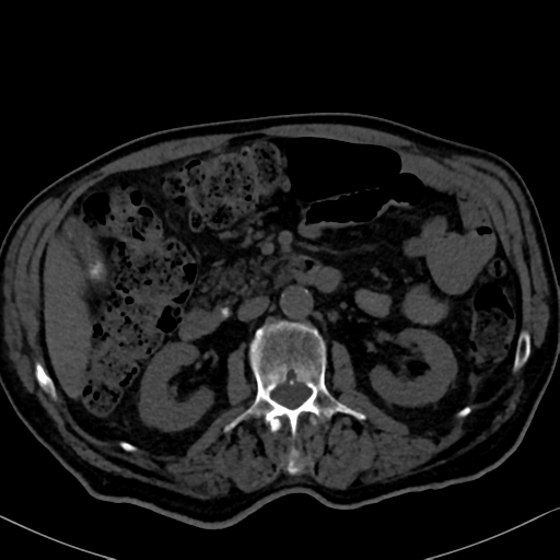 File:Normal CT intravenous cholangiogram (Radiopaedia 38199-40208 Axial IVC 50).png