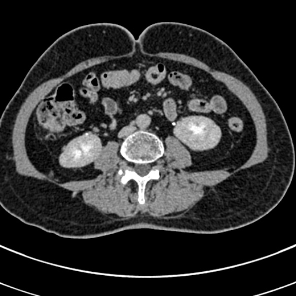 File:Normal CT split bolus study of the renal tract (Radiopaedia 48631-53634 Axial split bolus 139).jpg