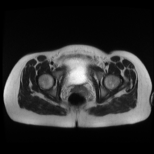 Normal MRI abdomen in pregnancy (Radiopaedia 88003-104546 Axial T2 47).jpg
