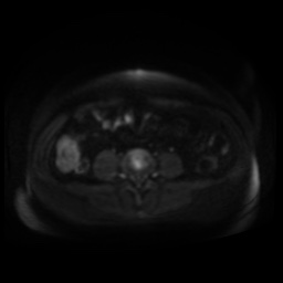 Normal MRI abdomen in pregnancy (Radiopaedia 88005-104548 Axial DWI 72).jpg