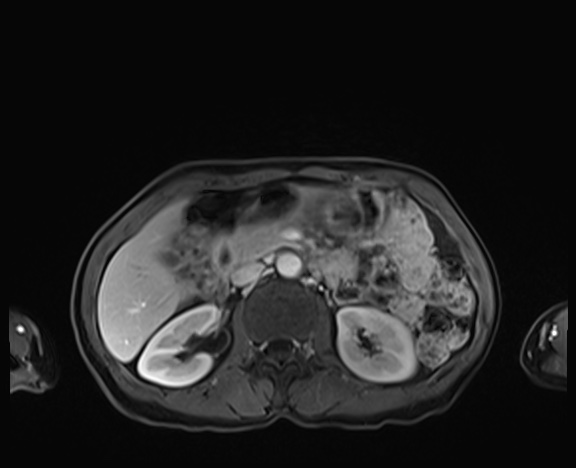 Normal adrenal glands MRI (Radiopaedia 82017-96004 K 39).jpg